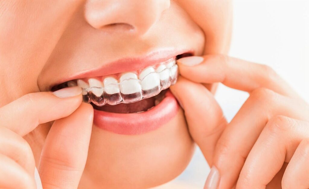 Елайнери для вирівнювання зубів за приємними цінами: тонкощі догляду за ротовою порожниною